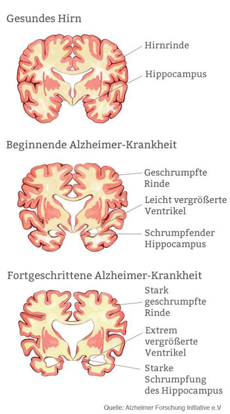 Alzheimer: Fakten, Verlauf, Lebenserwartung, Geschlechterverhältnis (wissenschaftliche Grafik)
