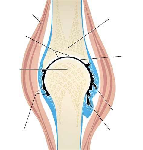 Anatomisches Schaubild eines arthrotischen Gelenks