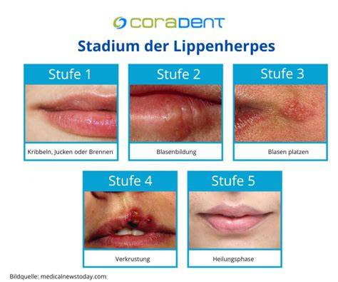 Anwendung von Honig auf Lippenherpes