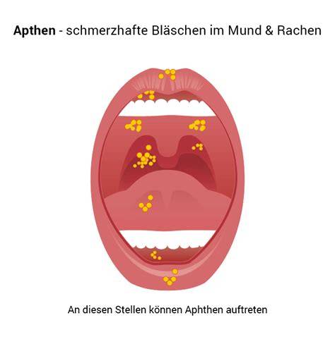 Aphthen Formen und Lokalisation