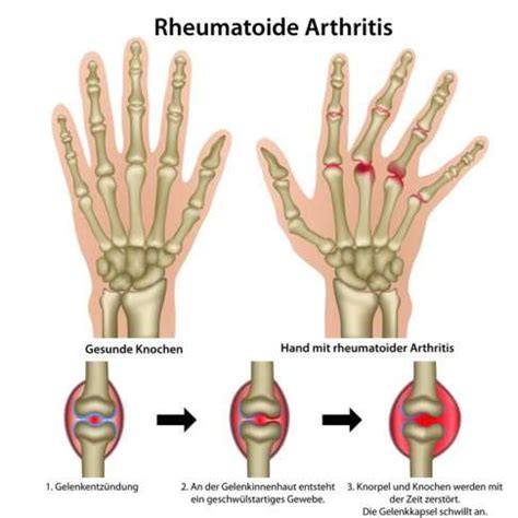 Arthritis urica: schmerzhaft geschwollenes Großzehengrundgelenk