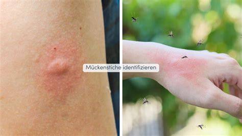 Auftragen von Honig auf einen Insektenstich