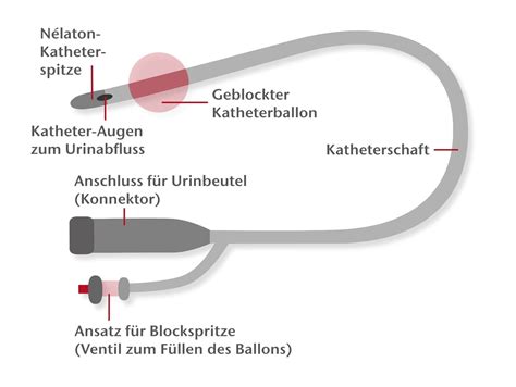 Ballonkatheter zur mechanischen Reifung des Muttermundes (schematisch)