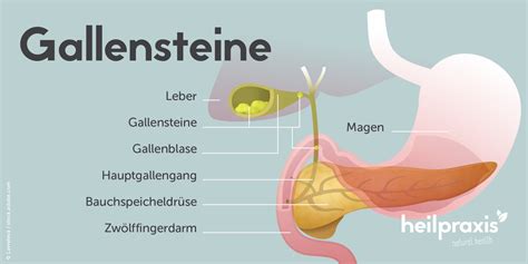 Darstellung der Gallensteine und Symptomorte