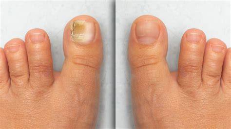 Darstellung von Nagelpilz am Fußnagel, Vergleich gesunder und befallener Nägel