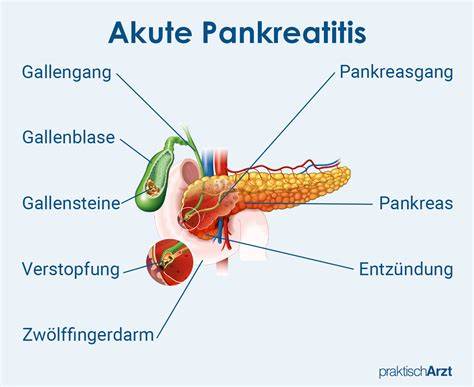Diagramm: Zusammenhang Zuckerkonsum und Risiko für chronische Pankreatitis