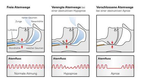 Diagramm zur Entstehung der obstruktiven Schlafapnoe