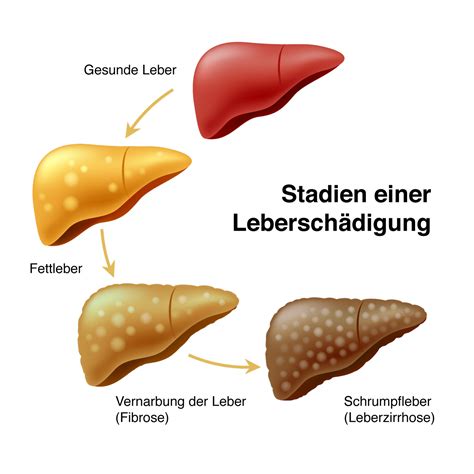 Fettleber durch Zucker und Fructose