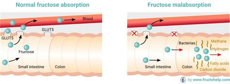 Fructosemalabsorption im Darm