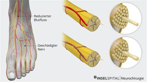 Grafik: Nervenschädigung an den Füßen bei Diabetes