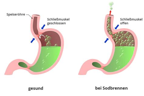 Grafik: Pathophysiologie von Sodbrennen