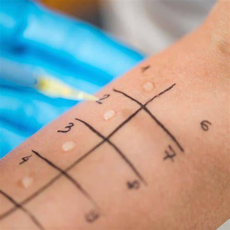 Grafik Allergietest an der Haut, Anwendungshinweis