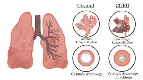 Händewaschen und Atemwegsprophylaxe bei COPD
