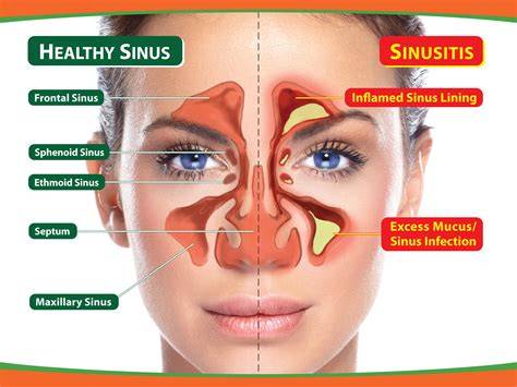 Hausmittel bei Sinusitis im Überblick