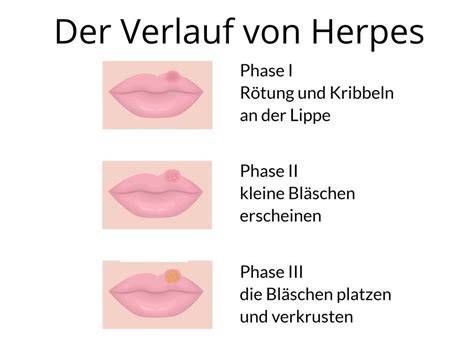 Herpes simplex: Viruszyklus und Symptome