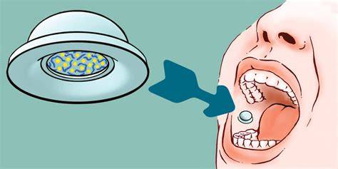 Illustration: Gabe von Dextrose-Gel in die Wangenschleimhaut