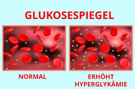 Illustration: Ursachen erhöhter Blutzuckerwerte