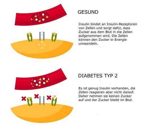 Illustration: Zusammenhang Zucker im Urin und Diabetes