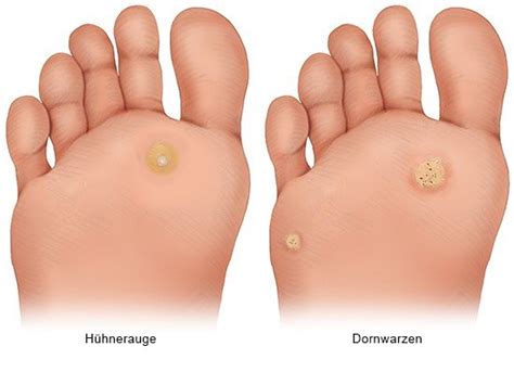 Illustration Fuß mit Hühnerauge und Druckstellen
