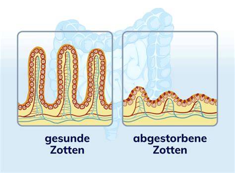 Illustration Zöliakie: Auswirkungen von Gluten auf den Darm