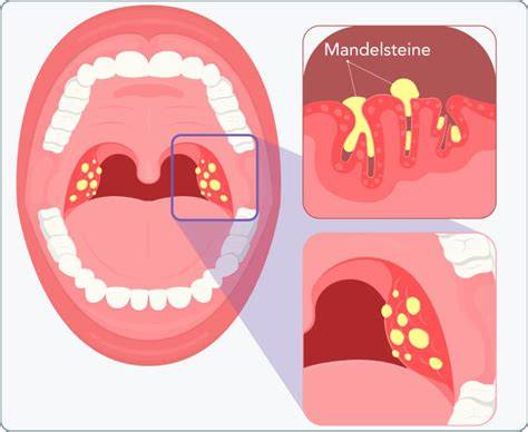 Illustration der Mandelsteine und Biofilm im Mandelbereich