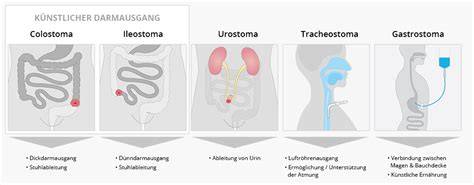 Illustration der drei Stomaarten: Ileostoma, Kolostoma, Urostoma
