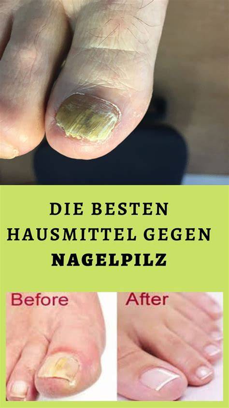 Infografik: Beliebte Hausmittel gegen Nagelpilz und ihre (vermutete) Wirkung
