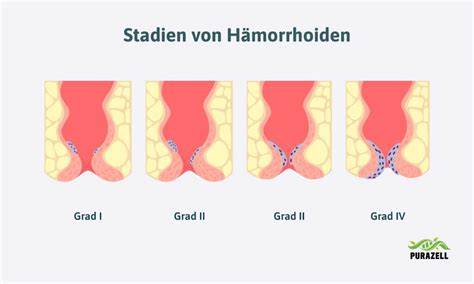 Infografik: Hämorrhoiden-Stadien (Grad 1-4)