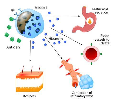 Infografik: Mechanismen der Urtikaria-Mastzellen, Histamin und Auslöser