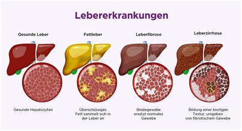 Infografik: Was passiert bei Fettleber in der Leber (Verfettung, Entzündung, Zirrhose)