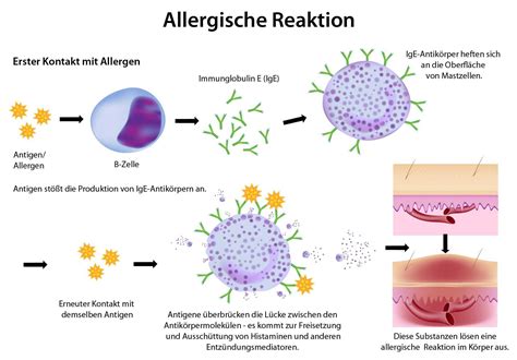 Infografik Allergische Reaktionen bei Schokolade