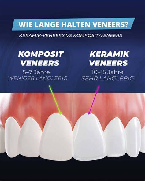 Infografik Veneers Kostenfaktoren