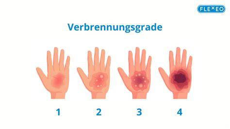 Infografik zu Ursachen, Verbrennungsgraden und Sofortmaßnahmen bei Verbrennungen