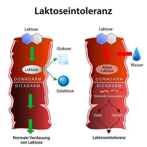 Laktoseintoleranz: Grafik Symptome und Ursachen