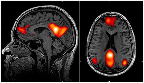 MRI: Gehirnaktivität und Default Mode Network unter Psilocybin