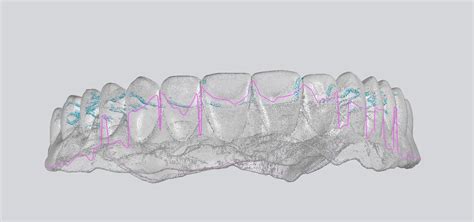 Maßgeschneiderte Schnarcherschiene mit digitalem 3D-Scan