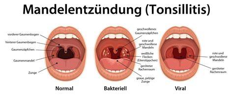 Mandelentzündung und Hausmittel Übersicht
