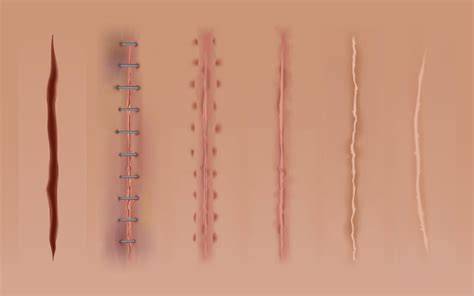 Narbenbildung auf der Haut - Infografik zu Narbentypen und schrittweisen Behandlungsoptionen