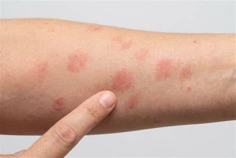Patch-Test auf Unterarm