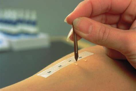 Prick-Test und Provokationstest - Diagnostik des OAS