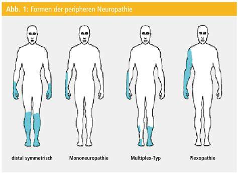 Schema: Ausbreitung der Symptome bei diabetischer Neuropathie