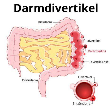 Schema: Ernährungsumstellung bei Divertikulitis