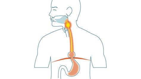 Schema: Magenreflux und Symptome (Sodbrennen, saures Aufstoßen)