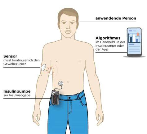 Schema CGM-System am Arm