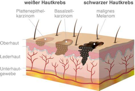 Schematische Abbildung: Unterschied zwischen dunkler und weißer Sachertorte