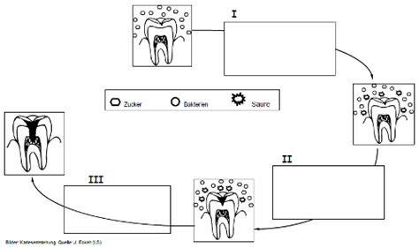 Schematische Darstellung: Entstehung von Karies durch Zucker