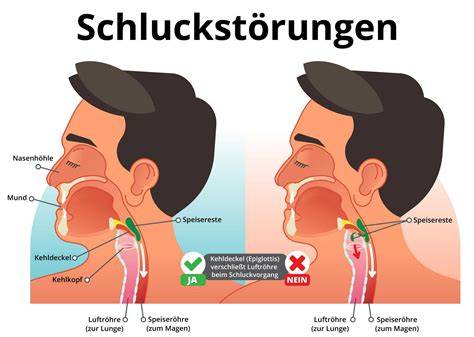 Schematische Darstellung: Reflux, Dysphagie und Schleimgefühl im Hals