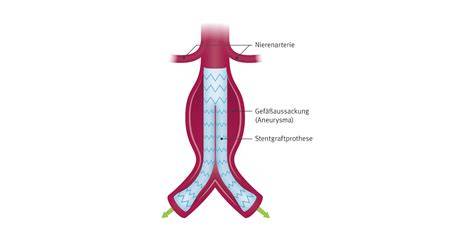 Schematische Darstellung der Aorta-Operation