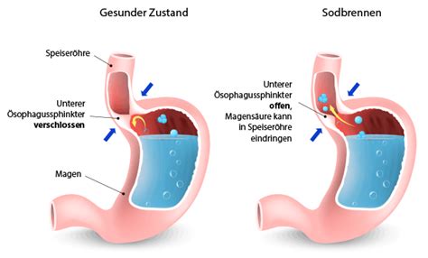 Schematische Darstellung der Entstehung von Sodbrennen