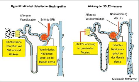 Schematische Darstellung der Wirkung von SGLT2-Hemmern